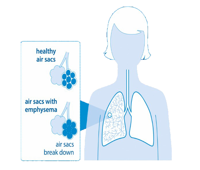 healthy-air-sacs